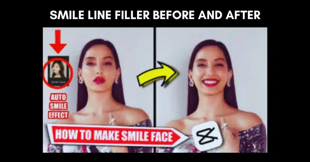 Smile Line Filler Before and After