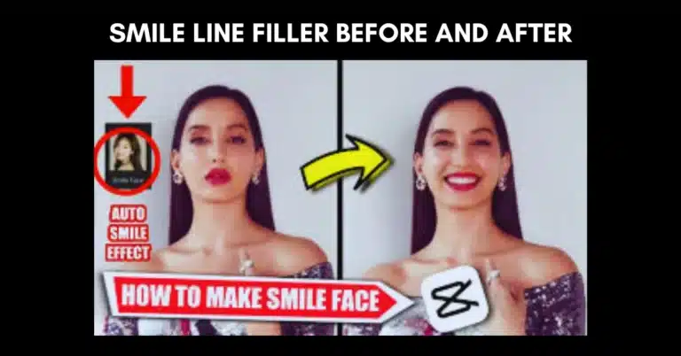 Smile Line Filler Before and After